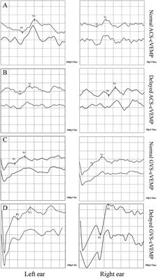 Potential vestibular pathway impairment in children with recurrent vertigo: An investigation through air-conducted sound and galvanic vestibular stimulation-triggered vestibular evoked myogenic potentials